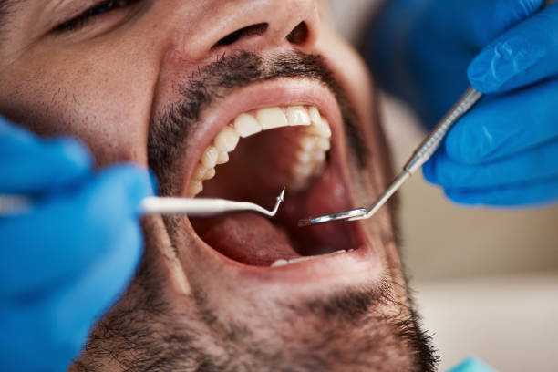 Best Knocked-Out Tooth (Avulsed Tooth) Treatment in Sun City Center, FL